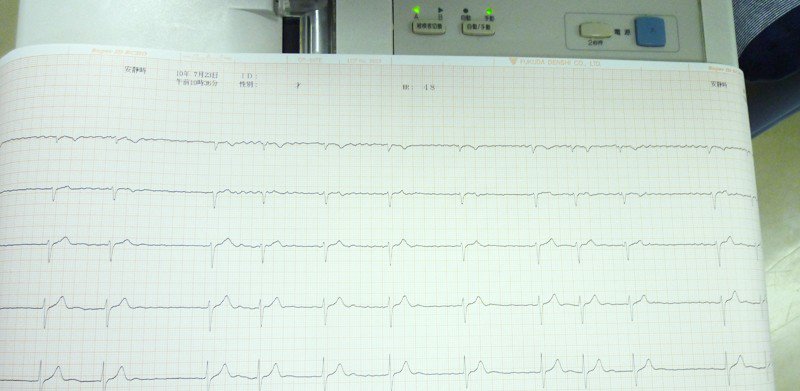 安静時心電図