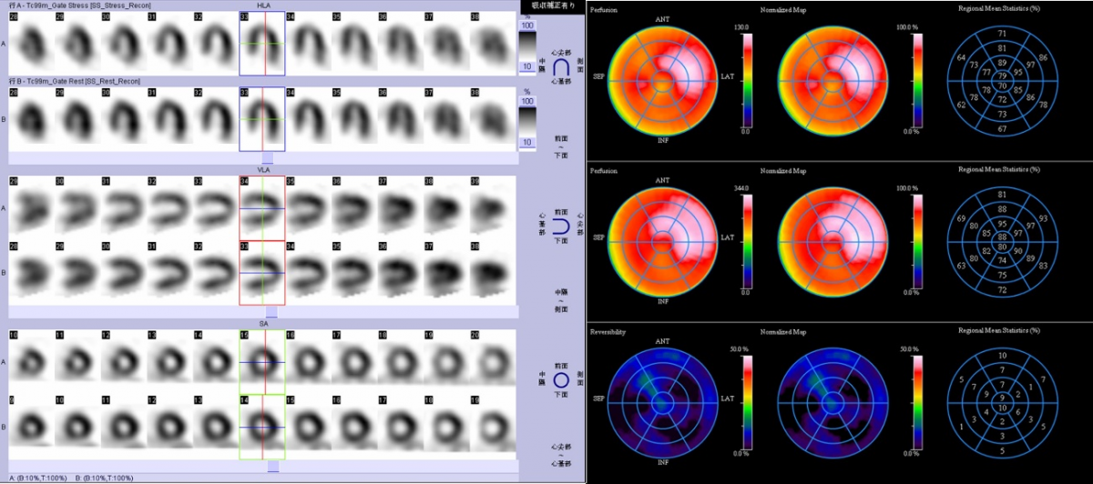 心臓シンチグラム画像