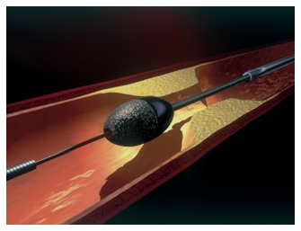 図2 ローターブレーター