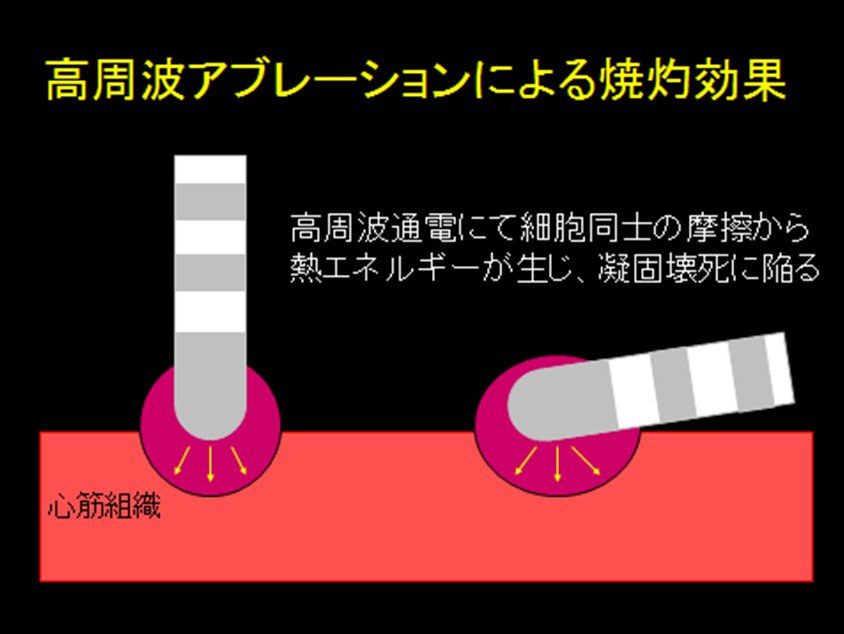 高周波アブレーションによる焼均効果