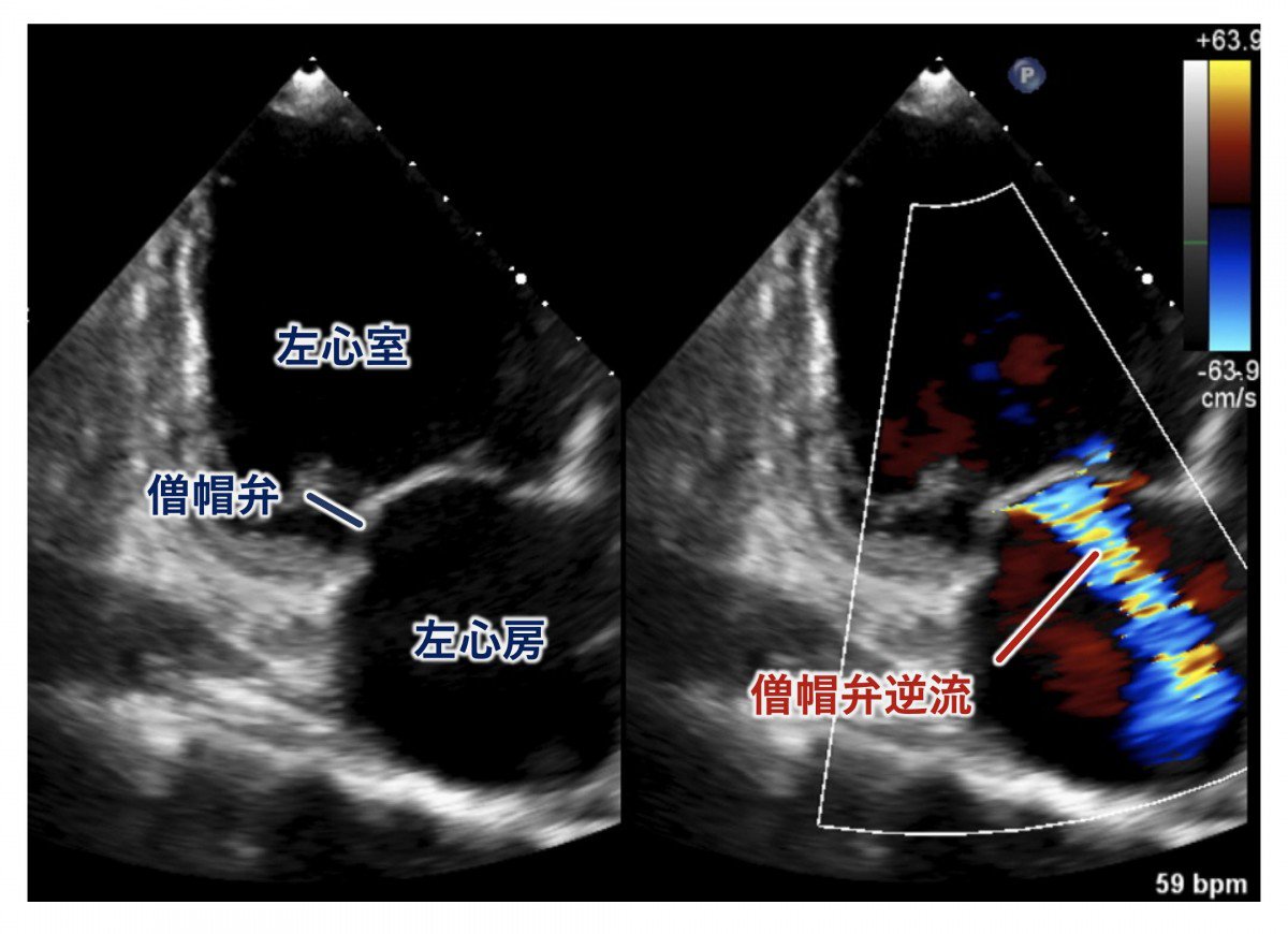 経胸壁心エコー図による僧帽弁逆流評価