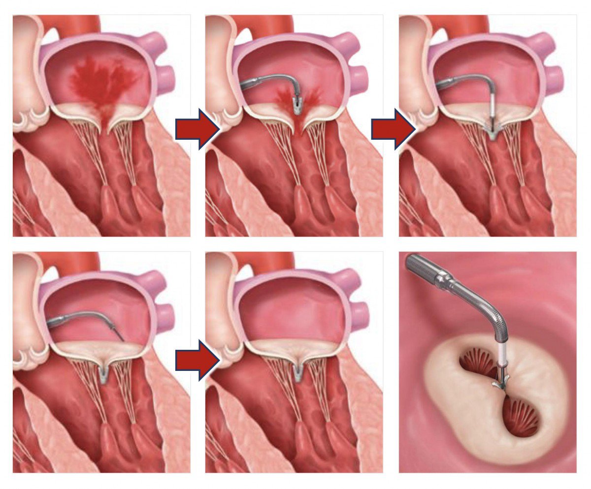 経皮的僧帽弁クリップ術による治療の流れ フローイメージ図
