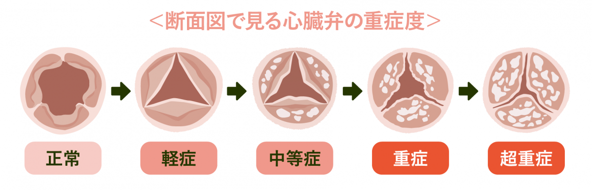 断面図で見る心臓弁の重症度